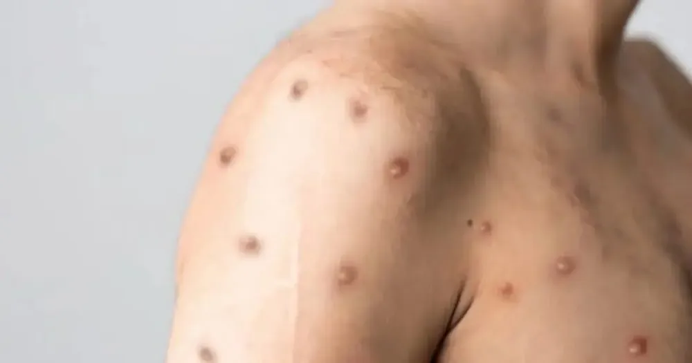 Vacinas contra mpox começam a ser distribuídas e aplicadas na África